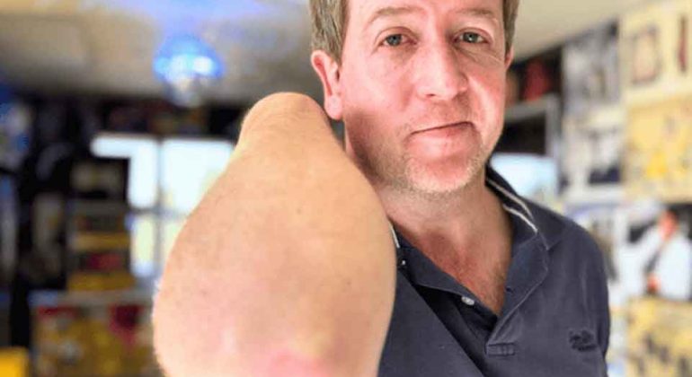 A man with short, light brown hair and a navy blue shirt is standing indoors, holding up his left arm, which is amputated above the elbow. The background is a brightly decorated room with yellow furniture.